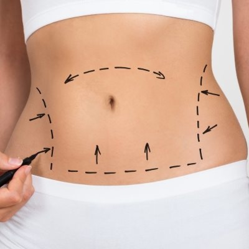 Tummy Tuck